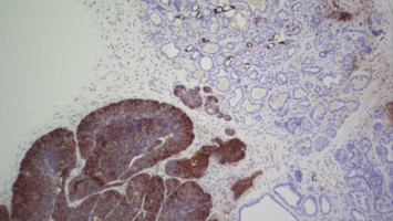 Researchers describe a molecular strategy that helps prevent tumour formation in mice