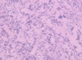 Phase III olaparib data shows improved PFS as maintenance therapy for gBRCA ovarian cancer