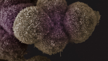 Pancreatic cancer tumour classification could optimise treatment choices