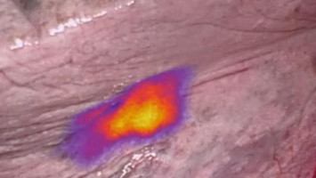 'Fluorescent markers' to illuminate cancer begins Phase 3 clinical trials