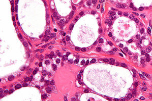 New research shows which ovarian cancer patients won't benefit from immune-PARP combo