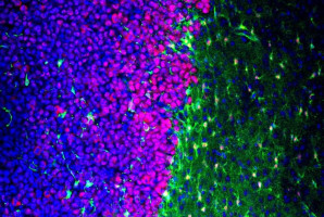 Scientists reveal brain tumours impact normally helpful cells
