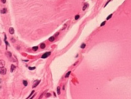 Drug targets hard-to-reach leukaemia stem cells responsible for relapses