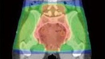 Researchers identify genes behind uterine leiomyosarcoma