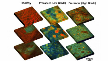 Cervical precancer identified by fluorescence, in a step toward bedside detection