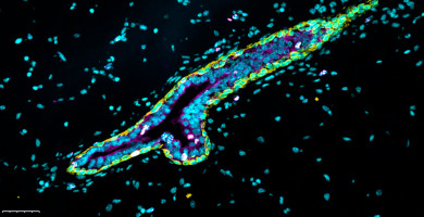 Identification of a determining factor in luminal cancer cells