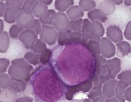 Helping healthy cells could be key to fighting leukaemia, research suggests