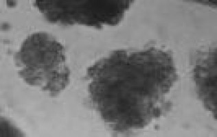 Un estudio revela la primera evidencia de que la genética heredada puede conducir a la propagación del cáncer