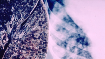 La FDA aprueba el brigatinib para el NSCLC metastásico positivo de ALK