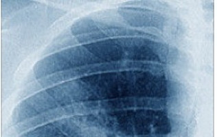 ASCO 2020: El Durvalumab añadido a la quimioterapia estándar mejoró la supervivencia general en el mesotelioma