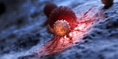 ASCO 2020: La inmunoterapia avelumab muestra potencial en el cáncer ginecológico raro resistente a la quimioterapia