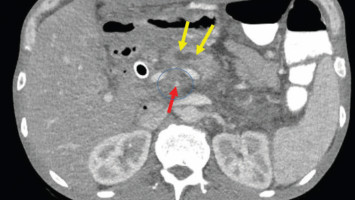 Preventing pancreatic cancer metastasis by keeping cells 'sheltered in place'