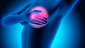 ASCO 2020: El trastuzumab logra una ligera reducción de la recurrencia en mujeres con DCIS HER2-positivo