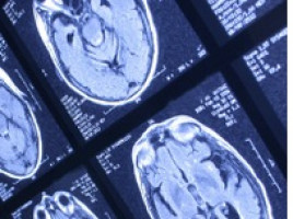 MicroRNA molecule may serve as biomarker, target for brain metastases in breast cancer patients