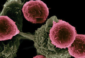La FDA aprueba el pembrolizumab para el carcinoma de células escamosas cutáneas
