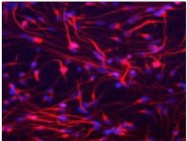 ASTRO: Prostate cancer patients surveyed 5 years after vessel-sparing RT report preserved sexual function