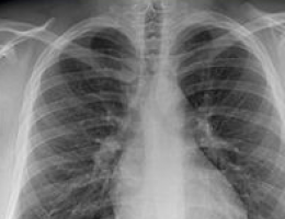 Se ha desarrollado una nueva herramienta para detectar a los pacientes de alto riesgo de padecer cáncer de pulmón.