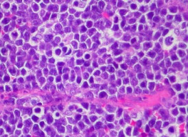 New drug target can break down cancer's barrier against treatment