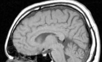Se han encontrado asociaciones inesperadas entre la respuesta a las drogas y los cambios celulares en el cáncer cerebral