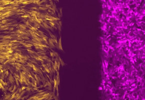 Una rara mutación del gen TP53 deja a las personas en mayor riesgo de padecer múltiples cánceres