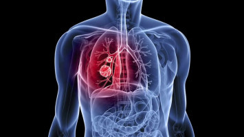 WCLC 2022: IMPower010: Overall survival interim analysis of a phase III study of atezolizumab vs best supportive care in resected NSCLC