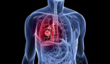 WCLC 2022: IMPower010: Overall survival interim analysis of a phase III study of atezolizumab vs best supportive care in resected NSCLC