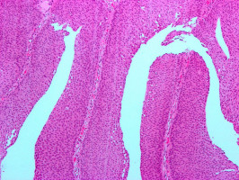 La quimioterapia para el cáncer raro afinada con organoides