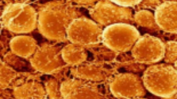 Primer modelo de organoide derivado de un paciente para el cáncer de cuello de útero