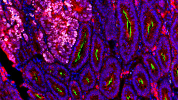 New insights into colorectal cancer: Growth factor R-spondin suppresses tumour growth