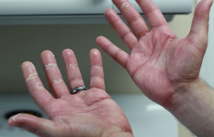 Factores genéticos asociados al síndrome mano-pie en la quimioterapia con capecitabina