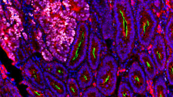 Nuevos conocimientos sobre el cáncer colorrectal: El factor de crecimiento R-spondin suprime el crecimiento del tumor