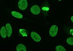 Patients’ own autoantibodies may hold key to boosting cancer immunotherapy response