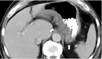 CT scans are the best alternative to colonoscopy to investigate bowel cancer symptoms
