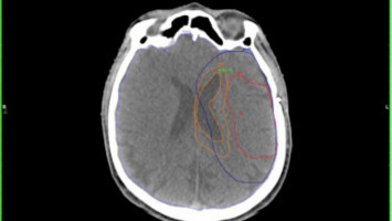 Los nuevos factores de ARN pueden ayudar a las células cancerosas a prosperar
