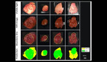 Near-infrared imaging and machine learning can identify hidden tumours
