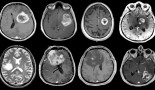 A progressive evolution in virtual MRI imaging for tumour detection