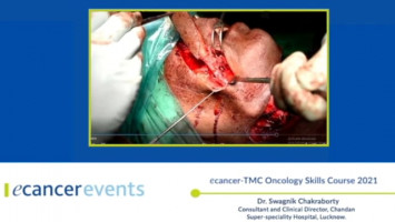 Island Nasolabial Flap ( Dr. Swagnik Chakraborty - Consultant and Clinical Director, Chandan Super-speciality Hospital, Lucknow. )