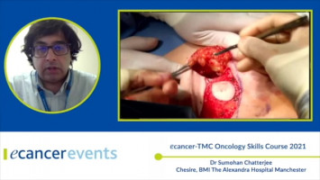 Grisotti Flap ( Dr Sumohan Chatterjee - Chesire, BMI The Alexandra Hospital Manchester )
