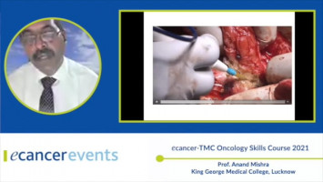 Wise pattern therapeutic mammoplasty ( Prof. Anand Mishra - King George Medical College, Lucknow )
