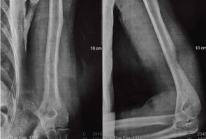 Blocking a cancer-related pathway helps reduce spine deformities due to genetic disorder, finds new study