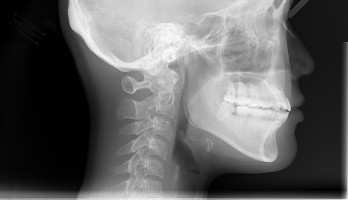 Machine learning predicts oral cancer risk