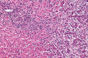 Longitudinal study sets new survival benchmark for patients with advanced biliary tract cancer