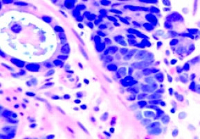 New biomarkers to help predict progression of Barrett’s oesophagus to adenocarcinoma