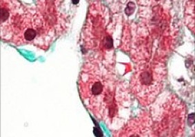 Oestrogen patches could offer a new treatment option for prostate cancer patients