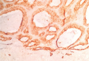 New bioinformatics tool to identify chromosomal alterations in tumour cells