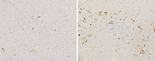 Custom molecule sBCMA-Fc V3 halts growth of multiple myeloma and diffuse large B cell lymphoma in mice