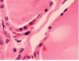 Gene profile may help identify risk for hormone-sensitive, hormone-insensitive breast cancer