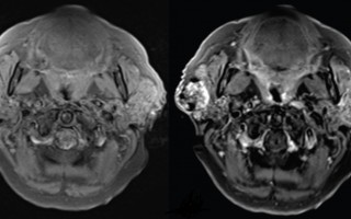 Most detailed map to date of breast tissue changes reveals role of menopause in cancer susceptibility