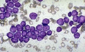 Researchers study use of dasatinib for patients with high-risk MDS