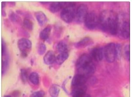 Arrhythmia drug may increase cancer risk